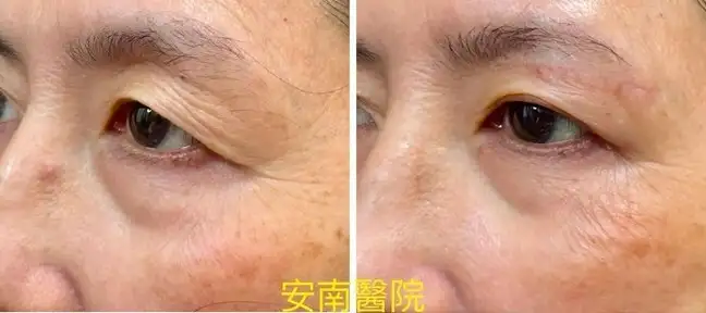 亚洲女性眼皮下垂救星！皮肤科主任揭6招保养＋手术重拾年轻明眸